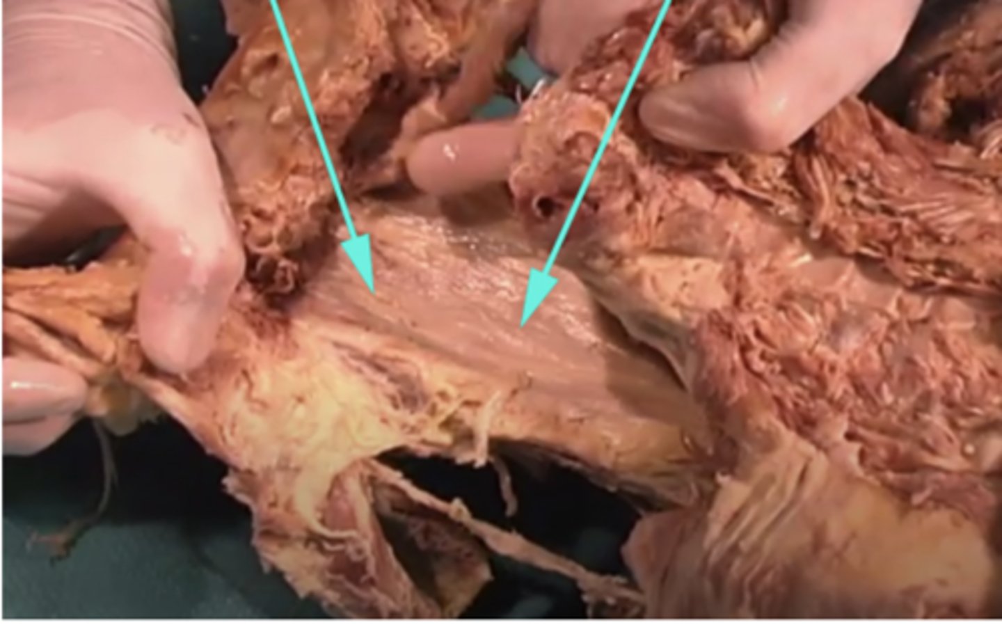 <p>What is this region being shown by the arrows?</p><p>-Jugular</p><p>-peripheral proteins</p><p>-Facial fascia</p><p>-Buccopharyngeal fascia</p>