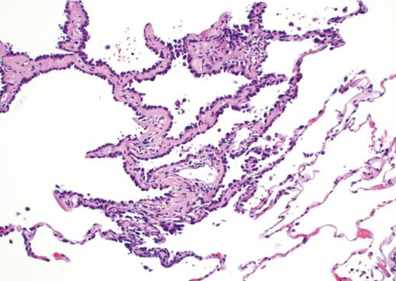 <p>Hiperplasia adenomatosa atípica</p>