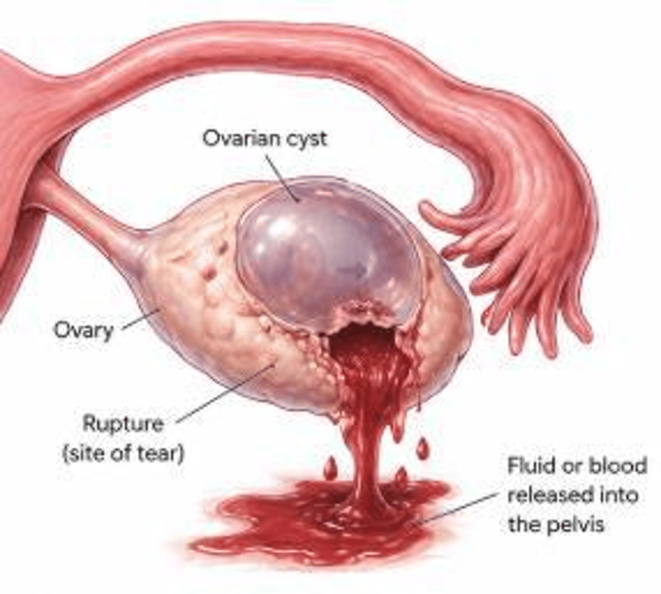 <p>Referred shoulder pain caused by hemoperitoneum irritating the diaphragm.</p>