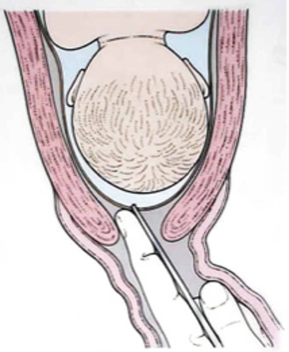 <p>incision into fetal membranes (to produce labor)</p>