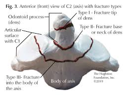 <p>what special feature does c2 vertebra possess?</p>