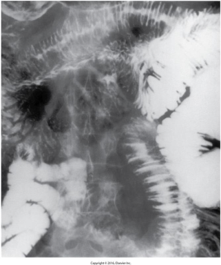 <p>purpura on xray </p>