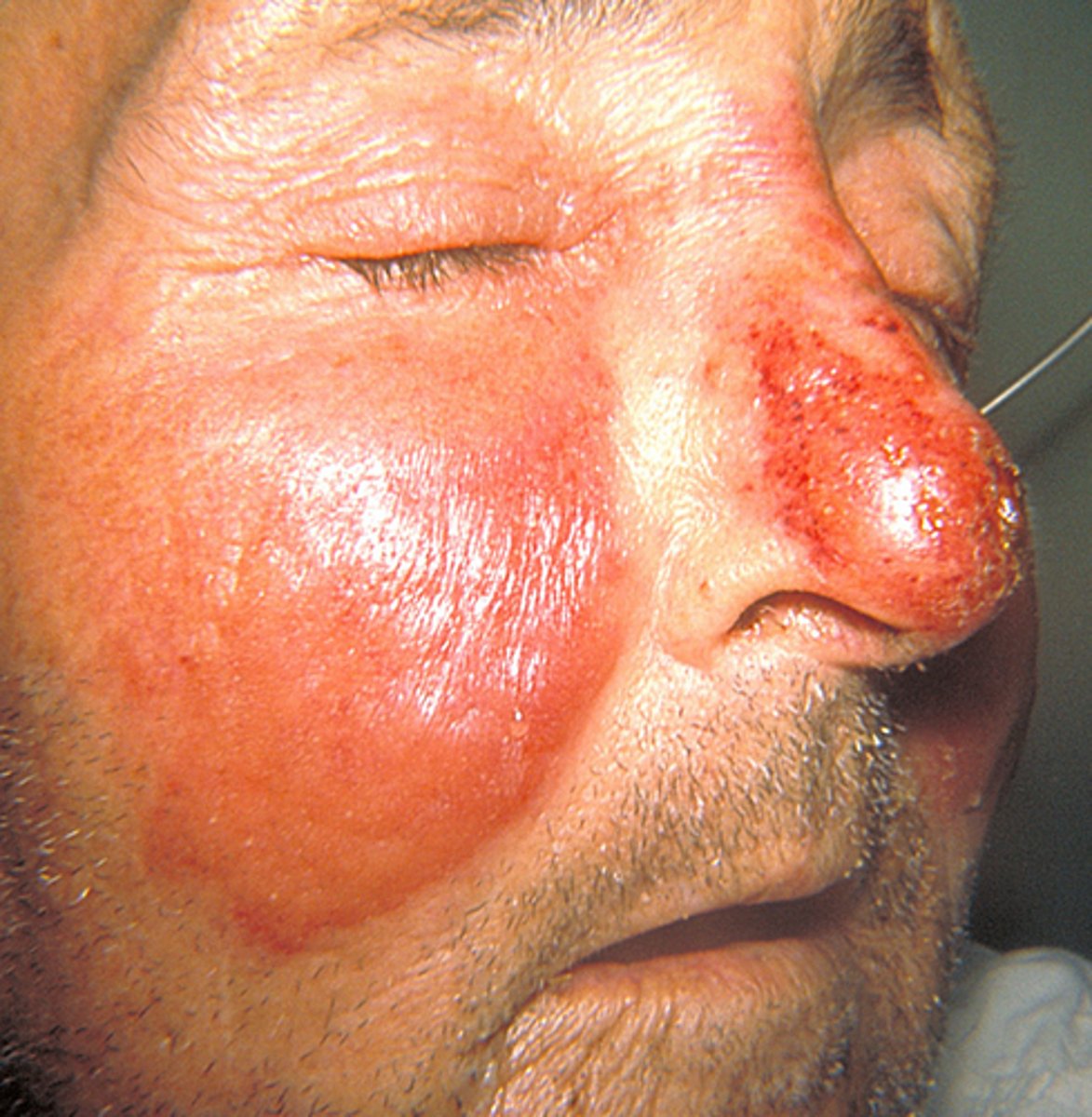 <p>a contagious disease of the skin and subcutaneous tissues caused by infection with streptococci organisms; redness and swelling of affected areas</p>