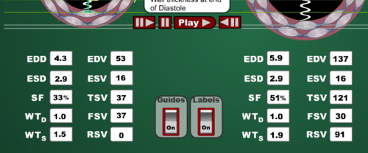 <p>Despite EDV and TSV being quite high, the FSV is lower then a normal heart</p>