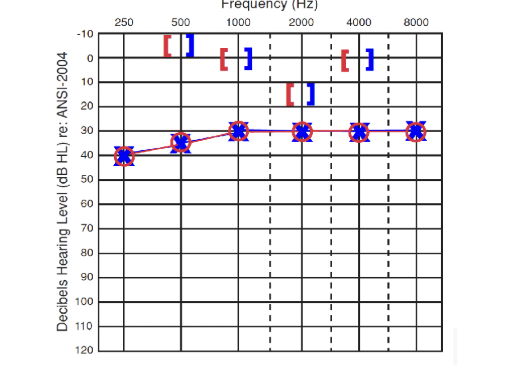 <p>Growth of spongy bone around the ossicular chair and stapes footplate (stiffens chain)</p><p>More common in pregnant women</p><p>Bilateral</p><p>Conductive Hearing Loss</p><p>Carhart Notch (10-15 db worse at 2000 Hz)</p>