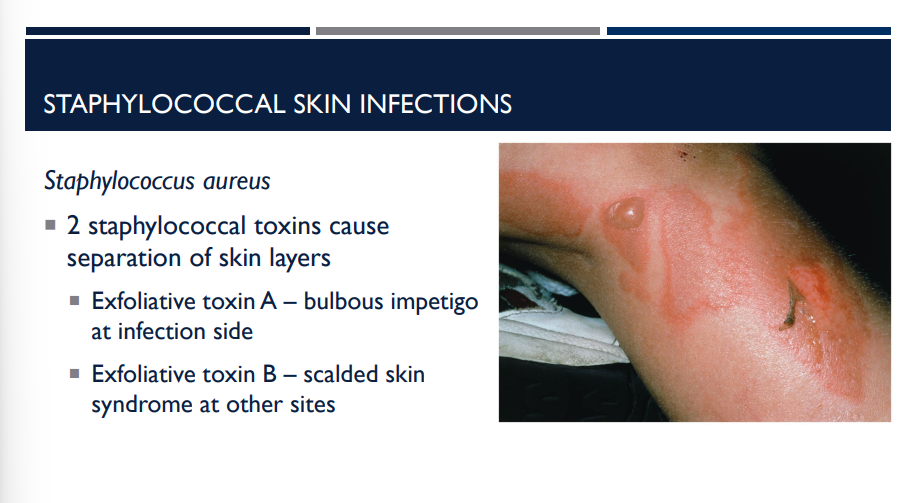 <p>In staphylococcal skin infections, 2 staphylococcal toxins cause separation of skin layers. Describe both. </p>