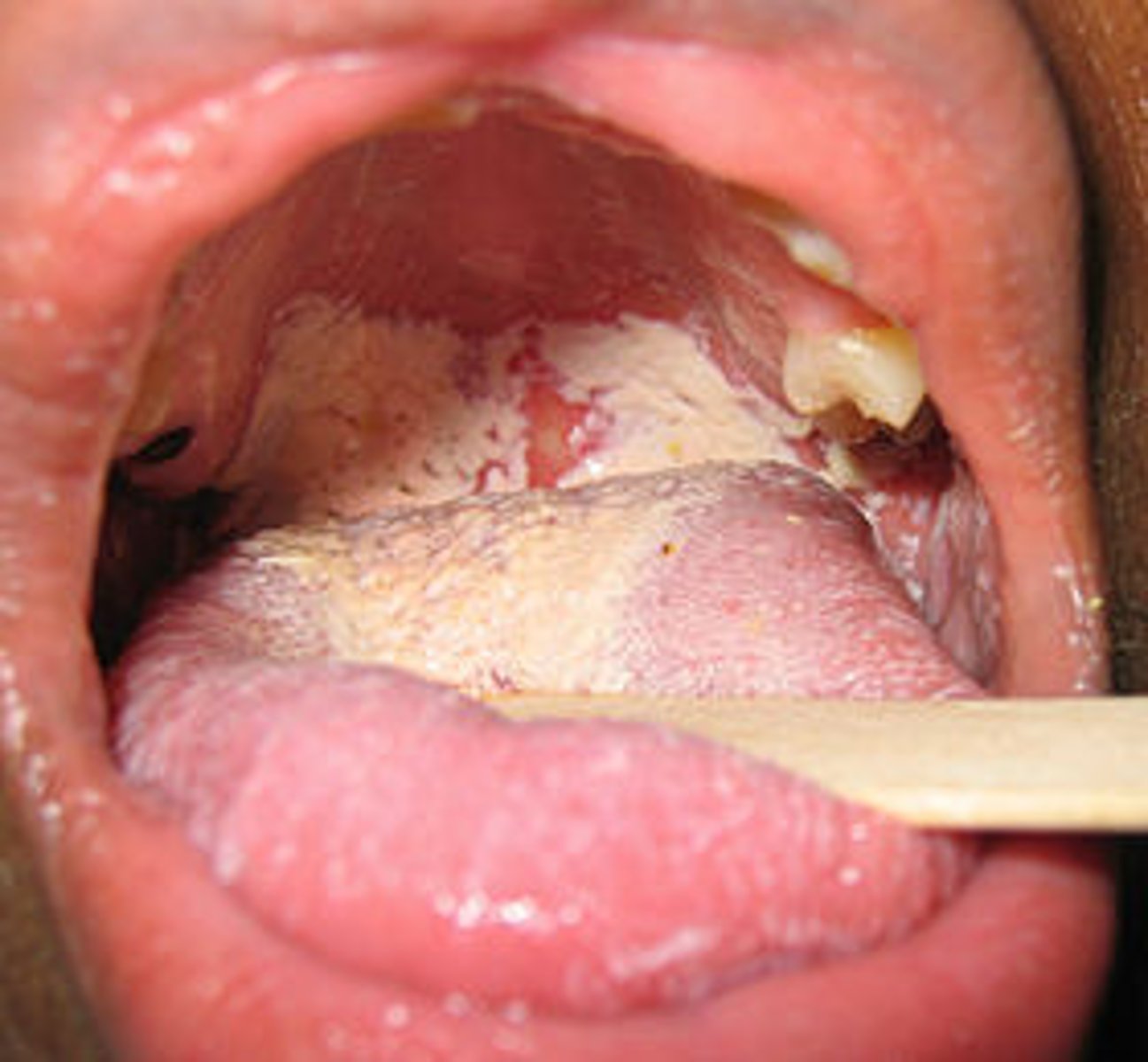 <p>c. "Are you taking any medications at present?"</p><p>The appearance of the lesions is consistent with an oral candidiasis (thrush) infection, which can occur in patients who are taking medications such as immunosuppressants or antibiotics. Candidiasis is not associated with poor oral hygiene or lower respiratory infections. The lesions do not look like an oral herpes infection</p>