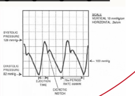 <ul><li><p>real time - beat by beat</p></li><li><p>gives more information from trace</p></li><li><p>more accurate</p></li><li><p>insert a cannula into a peripheral artery</p></li><li><p>connect a cannula to transducer</p></li><li><p>reported as systolic/diastolic and (mean)</p></li></ul><p></p>