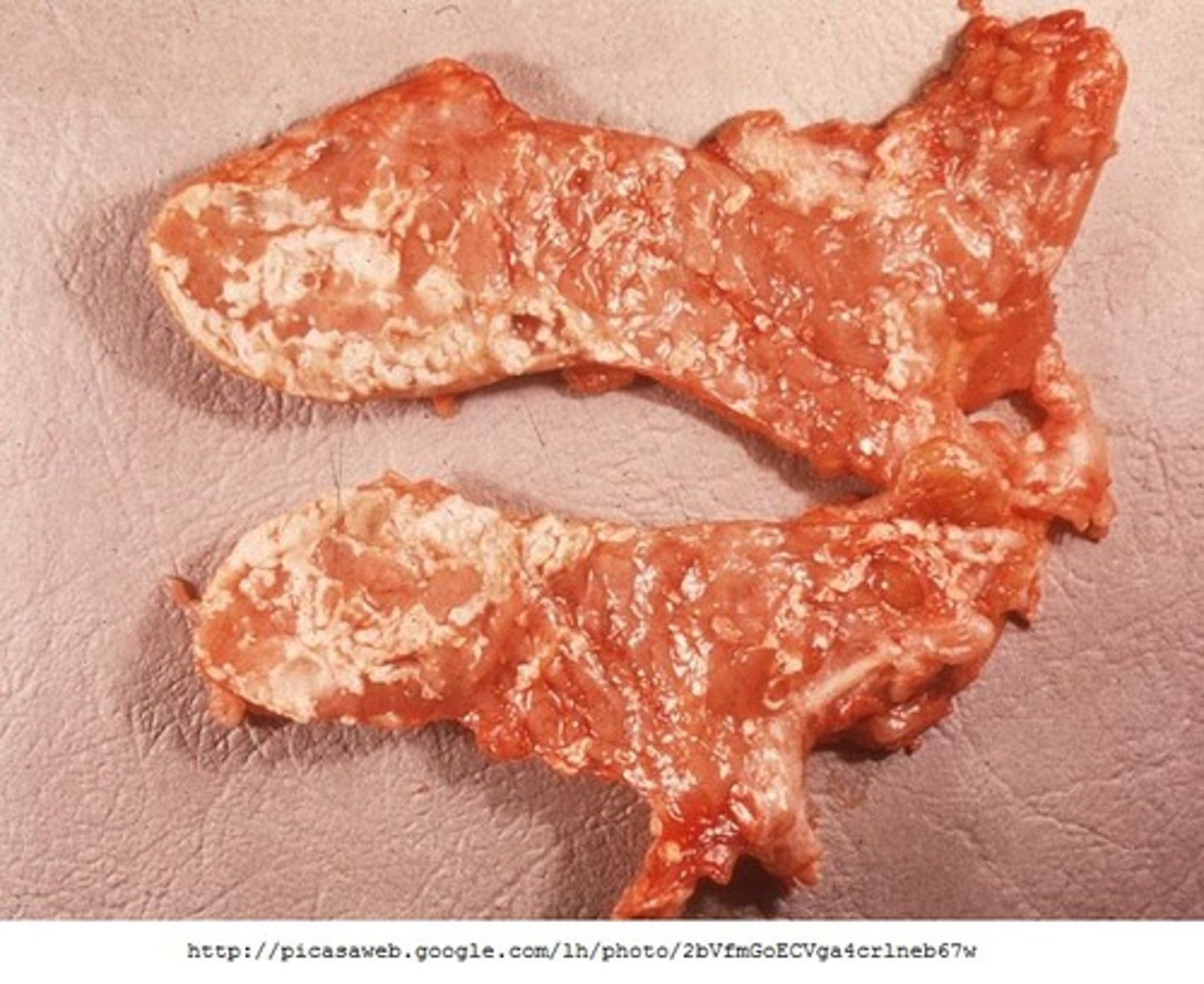 <p>- breast cancer/other abdominal organs/pancreas</p><p>- cellular death in area of fatty tissue, usually harmless, can be surgically removed if bothersome, can go away on its own</p>
