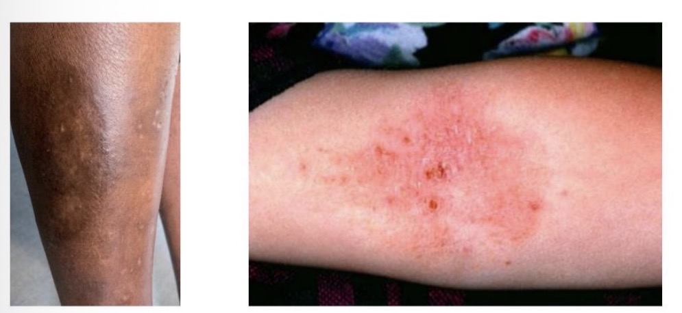 <ul><li><p>Eczema and dermatitis (interchangeable)</p></li><li><p>Most common - atopic eczema, contact dermatitis</p></li><li><p>External - irritants/allergens, Internal - genetic cause</p></li><li><p>Emotional or environmental factors can trigger flare up</p></li><li><p>Lipid layer that covers skin becomes thin causing water loss</p></li><li><p>Long term relapsing condition, in children improves with time</p></li><li><p>Symptoms - redness, dry itchy skin, localised to flexures of limbs, usually symmetrical, scratch marks, damage, thickening</p></li><li><p>Treatments can control but no cure</p></li></ul><p></p>