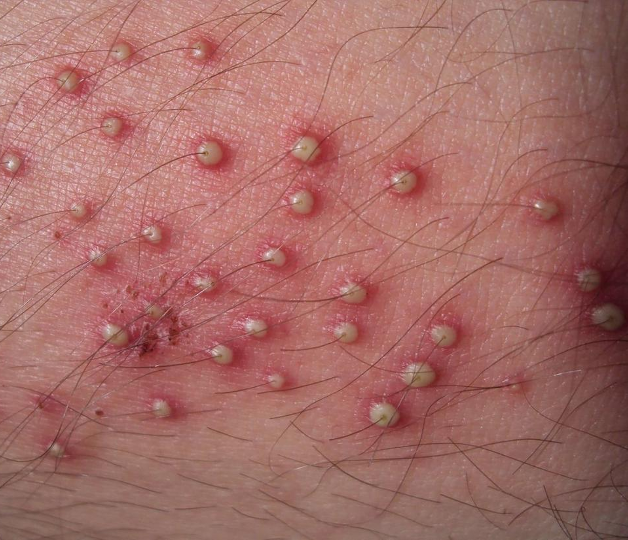 <p>superficial (epidermis) infection of hair follicles; </p><p>usually resolves on its own w/ sx care- warm compresses TID, avoid shaving </p>