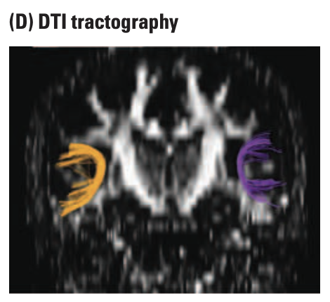 diffusion tensor imaging (DTI)