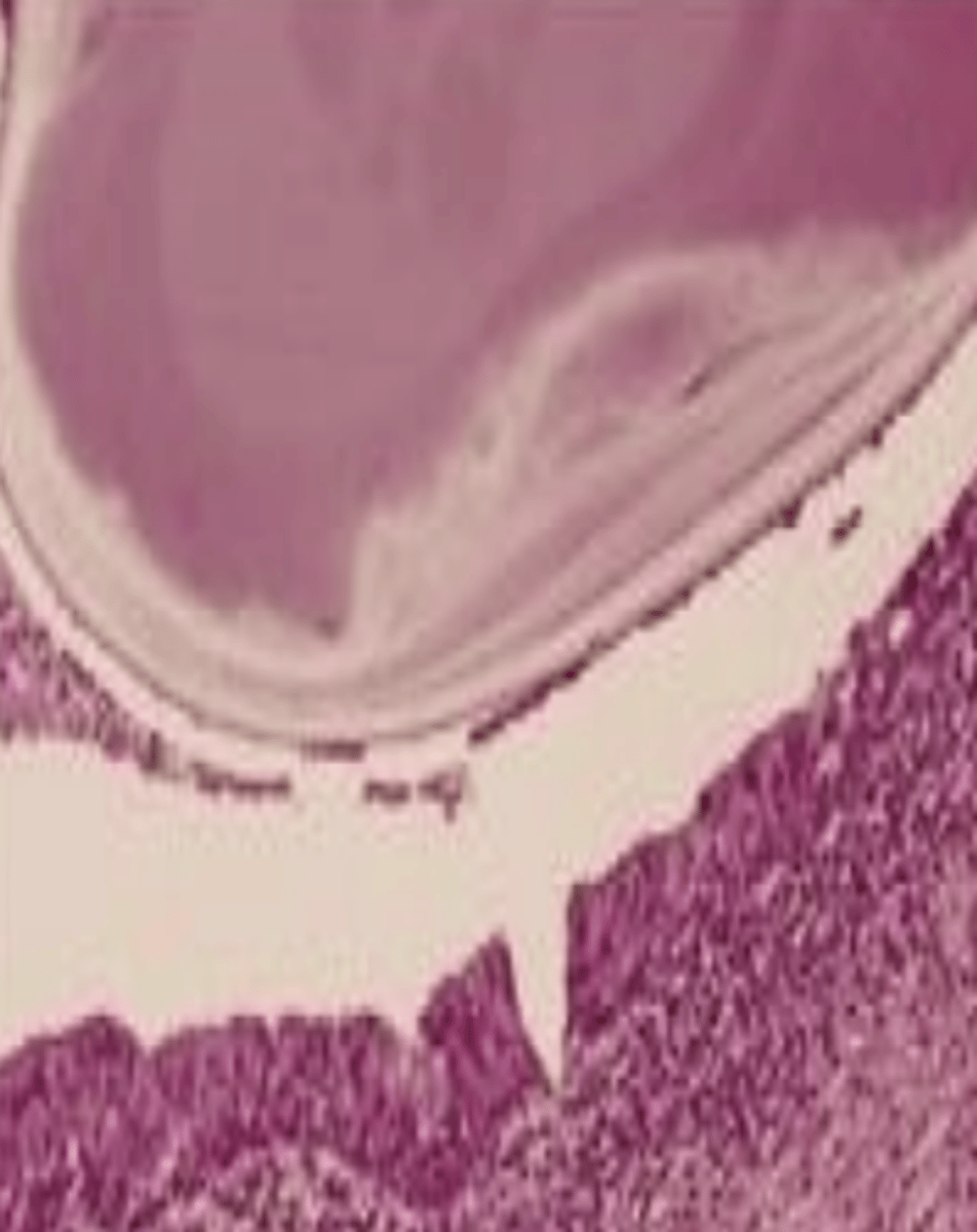 <p>These histologic characteristics are indicative of what oral pathology?</p><p>calcified mass surrounded by inflamed and fibrotic salivary glands</p>