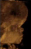 <ol><li><p>What is abnormal about this image?</p></li><li><p>This finding can be associated with what pathology?</p></li></ol><p></p>