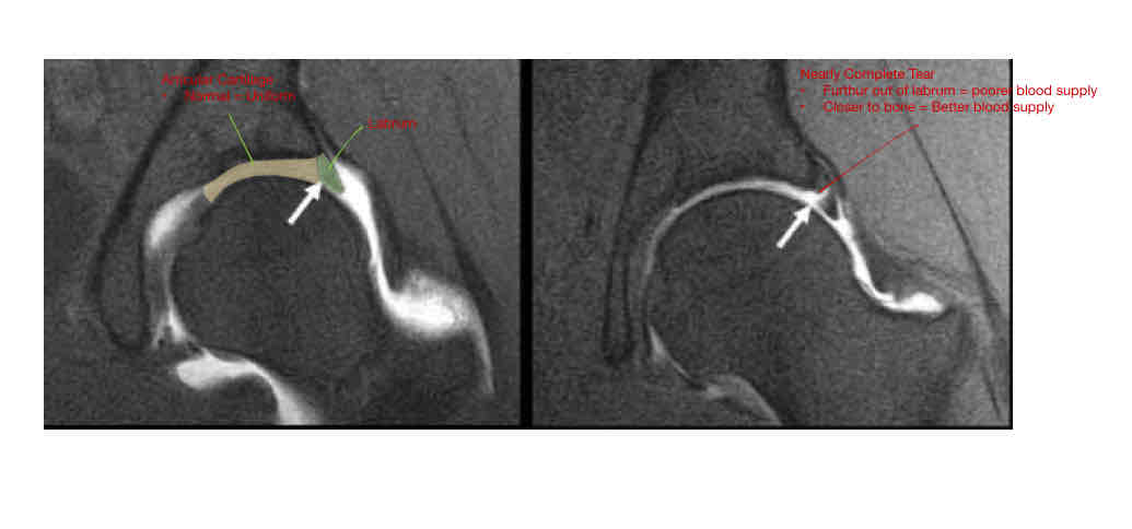 <ul><li><p>Acute Vs Degenerative</p></li><li><p>Pop: Younger </p></li></ul><p></p>