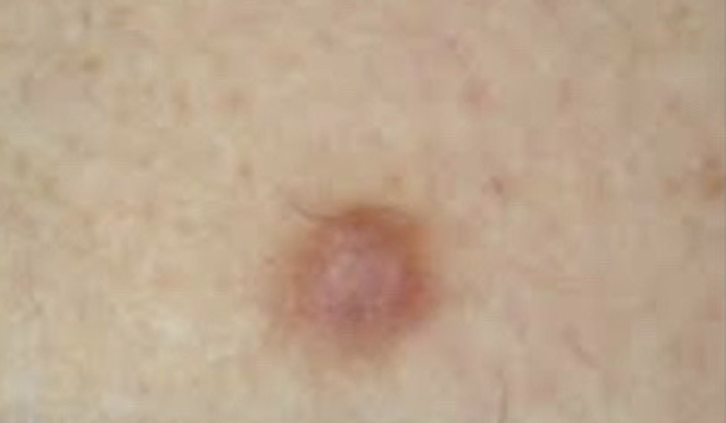 <p>Dermatofibroma</p>