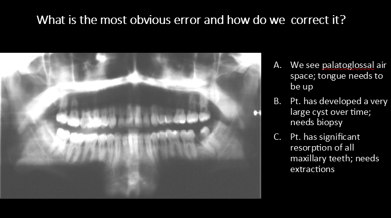 <p>What is the most obvious error and how do we  correct it?</p><p>A. We see palatoglossal air space; tongue needs to be up</p><p>B. Pt. has developed a very large cyst over time; needs biopsy</p><p>C. Pt. has significant resorption of all maxillary teeth; needs extractions</p>