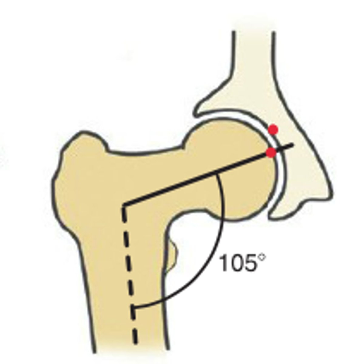 <p>1. What angle is being shown here?</p><p>2. What does this angle measured cause at the hip?</p><p>3. What does this result in at the knee?</p>