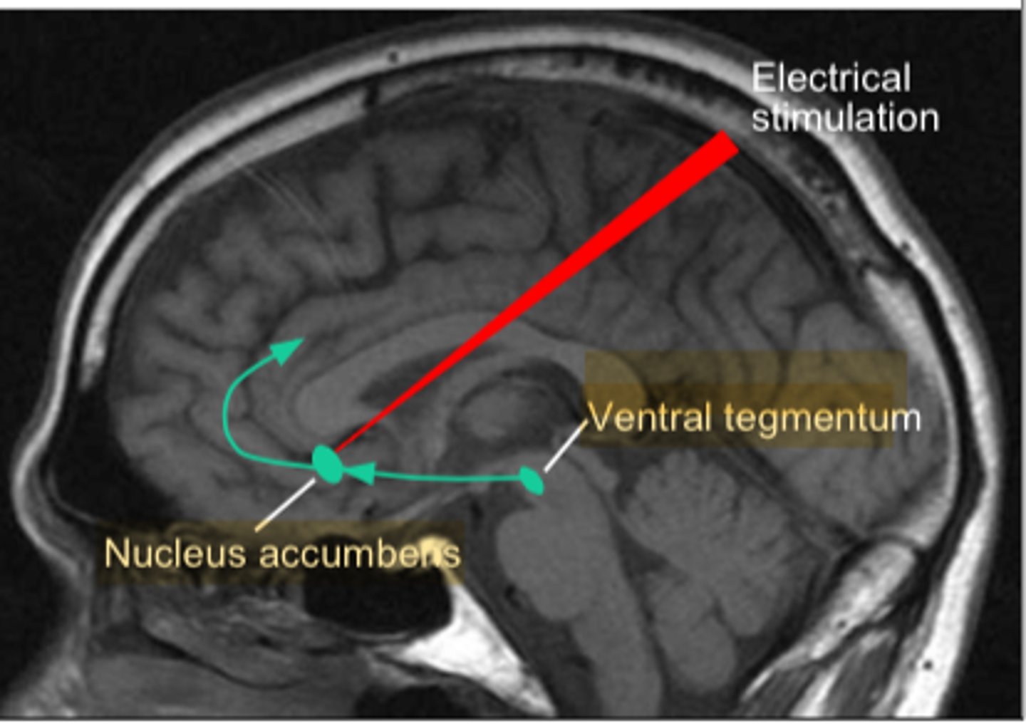 <p>a subcortical structure that participates in reward and addiction</p>