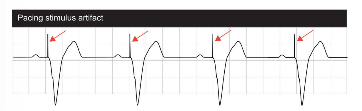 <p><span>The </span><strong>spike on ECG</strong><span> showing the pacemaker sent a signal</span></p>
