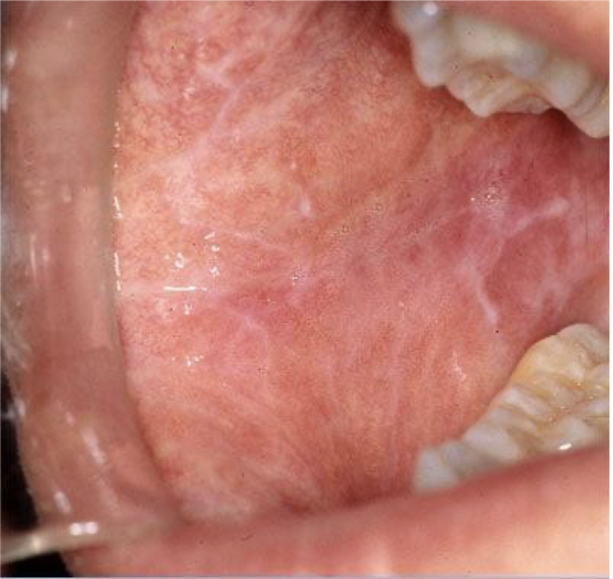 <p>A 45 year old patient presented with bilateral white lace like patches throughout buccal mucosa. There is mild burning sensation on eating. What is your diagnosis? Provide one differential diagnosis</p>