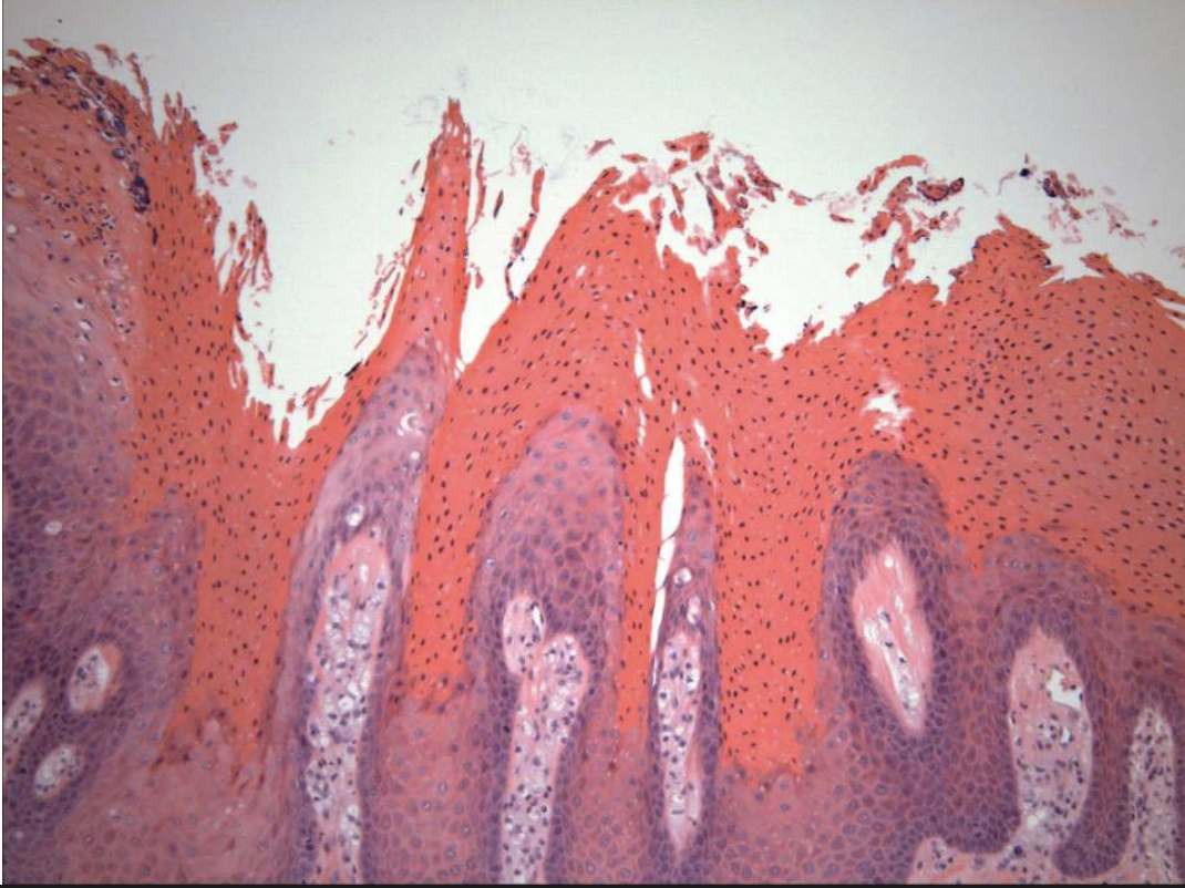<ul><li><p>Papillary, acanthotic surface covered by parakeratin</p></li><li><p>Large macrophages with foamy cytoplasma</p><img src="https://knowt-user-attachments.s3.amazonaws.com/95faf957-489f-4126-93a1-e51bbb09a0e1.png" data-width="100%" data-align="center"></li></ul><p></p>