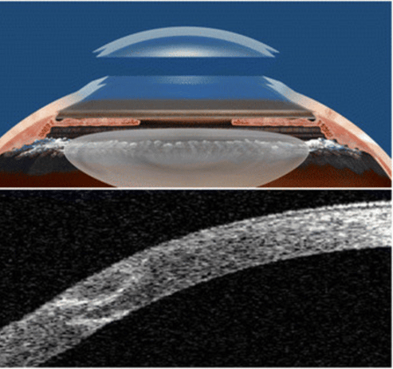 <p>What is alternatively used to make the full thickness cut in PKP?</p>