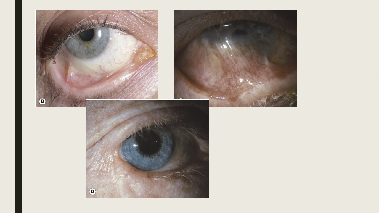 <ul><li><p>Bilateral, but asymmetric condition.&nbsp;</p></li><li><p>Insidious onset</p></li><li><p>Conj:</p><ul><li><p>papillary reaction</p></li><li><p>diffuse hyperemia and chemosis</p></li><li><p>flatenning of the plica and keratinization of the caruncle</p></li><li><p>conj fibrosis and shortening of inferior fornix</p></li><li><p>symblepharon-adhesions between the bulbar and palpebral conj</p></li><li><p>destruction of goblet cells and accessory lacrimal glands </p></li><li><p>Necrosis in sever cases</p></li></ul></li><li><p>Cornea: PEE, vascularization, infiltrates, keratinization of cornea d/t limbal stem cell failure </p></li><li><p>Eyelid: aberrant lashes, blepharitis, keratinization of the lid margin, ankyloblepharon-connection of upper and lower lid at the lateral canthus </p></li></ul><p></p>