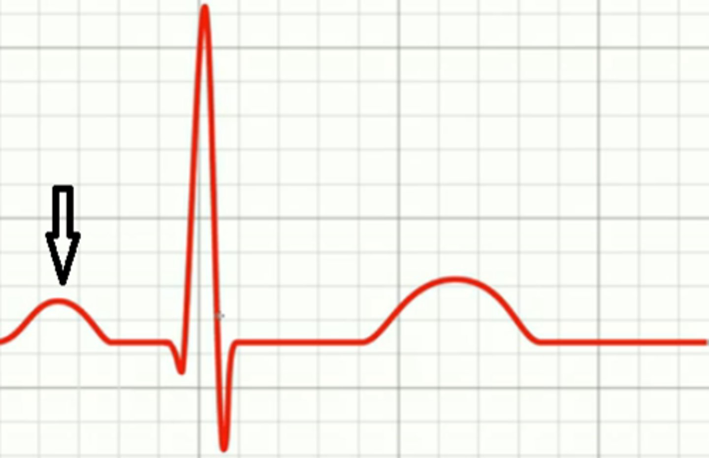<p>Atrial depolarization (contraction)</p>