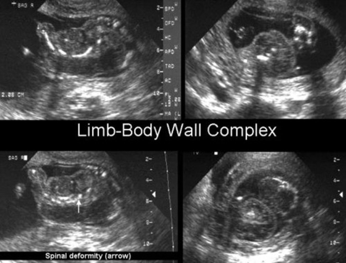 <p>Thoracoschisis, abdominoschisis, limbdeformities, craniofacial defects, spinal anomalies/scoliosis, urogenitalabnormalities</p>