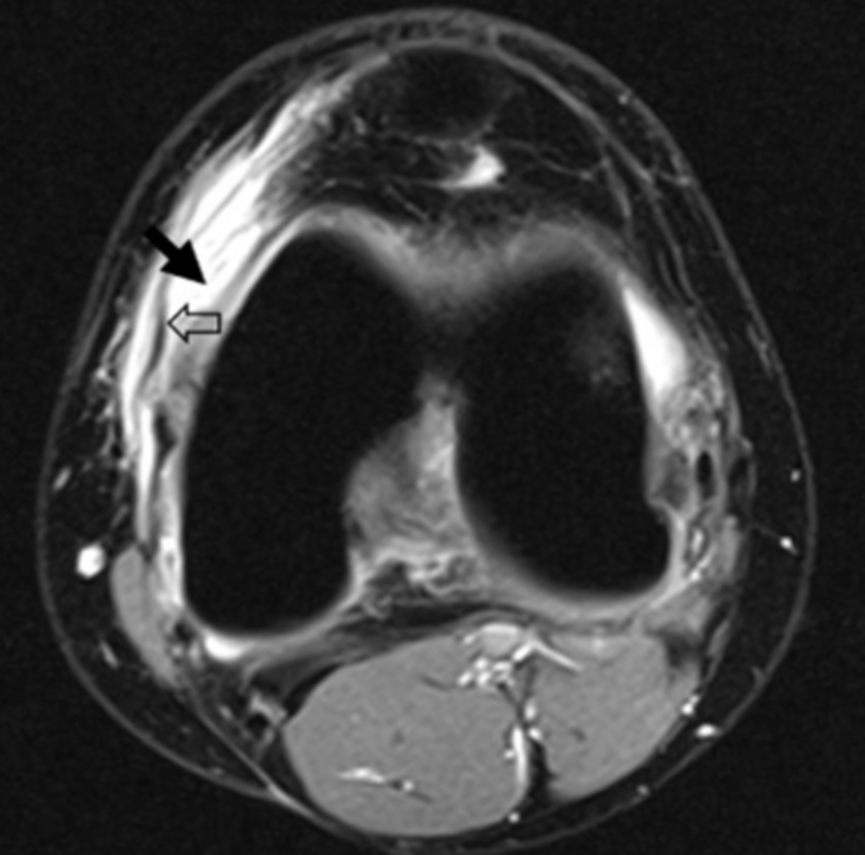 <p>This is an axial T2 image at the level of the femoral condyles. The open arrow points to the medial patellar retinaculum. What does the solid arrow point to?</p><p>a. Edema</p><p>b. Fatty tumor</p><p>c. Hemorrhage</p><p>d. Osteogenic tumor</p>