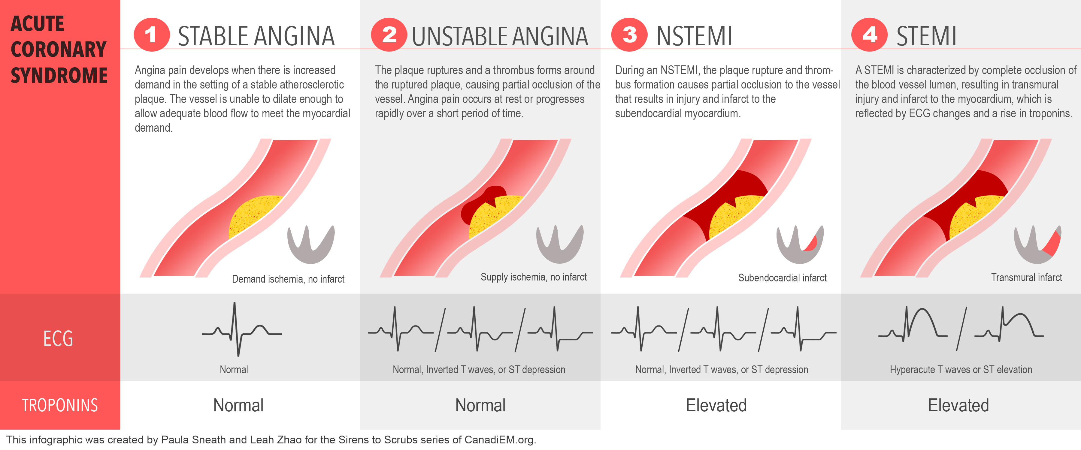 <ul><li><p><span>STEMI is characterised by transmural ischemia (lack of blood flow affecting the entire thickness of myocardium), myocardial necrosis, and release of specific chemical biomarkers, and ECG changes</span></p></li></ul><ul><li><p><span>In STEMI the thrombus is mostly occlusive</span></p></li><li><p><span>ST elevation is a sign of complete occlusion by thrombus causing immediate myocardial death of the area affected</span></p></li></ul><ul><li><p><span>NSTEMI is characterised by myocardial ischemia, myocardial necrosis, and changes of chemical biomarkers, but does not show ECG changes</span></p></li><li><p><span>In NSTEMI and UA there is partial coronary occlusion</span></p></li></ul><p></p>