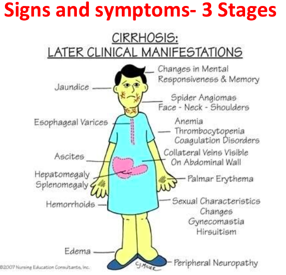 <ul><li><p>esophageal varices & portal hypertension </p></li><li><p>ascites</p></li><li><p>hepatic encephalopathy (due to high ammonia levels <span><span>→ must be on seizure precautions and mild protein)</span></span></p></li></ul><p></p>