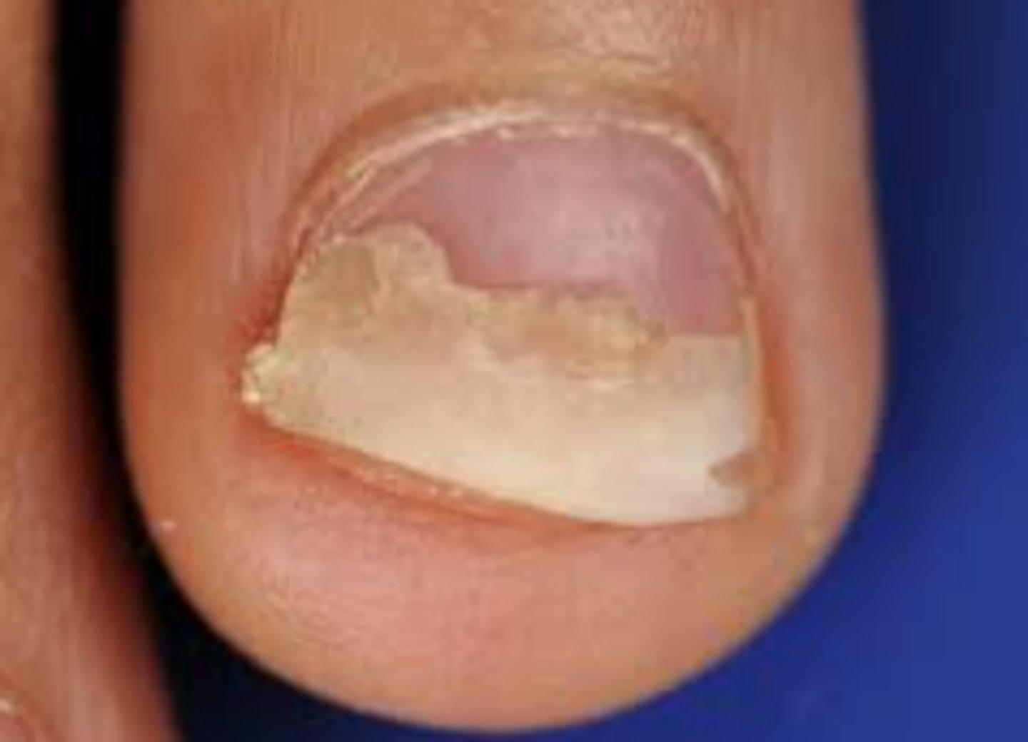 <p>= proximale loslating van de nagels</p>