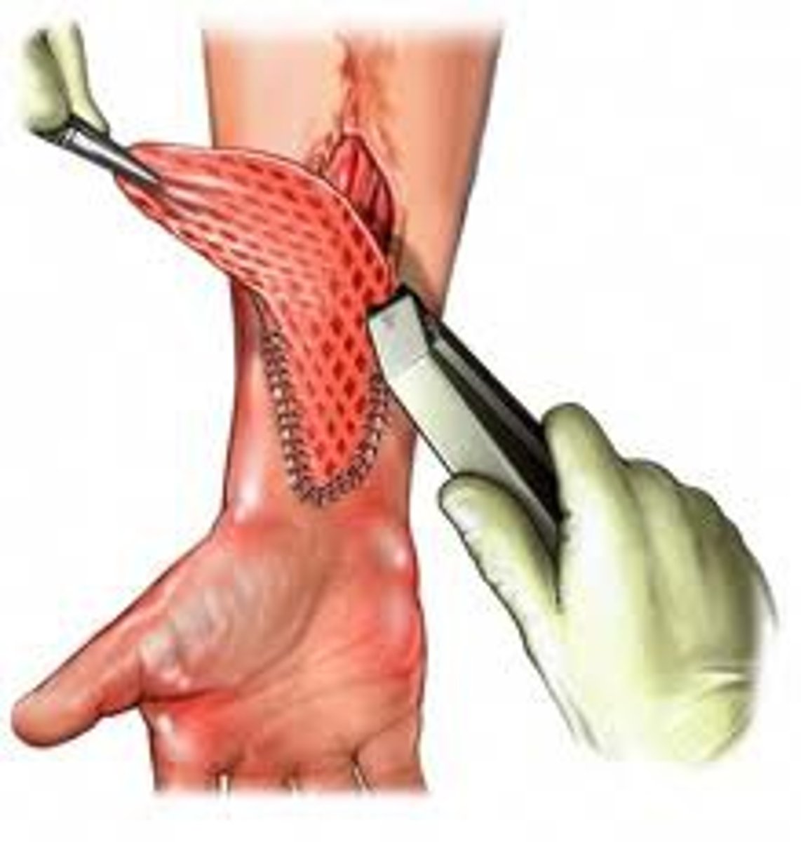 <p>Reduces the amount of fluid in a wound, makes the skin more likely to "take"</p>