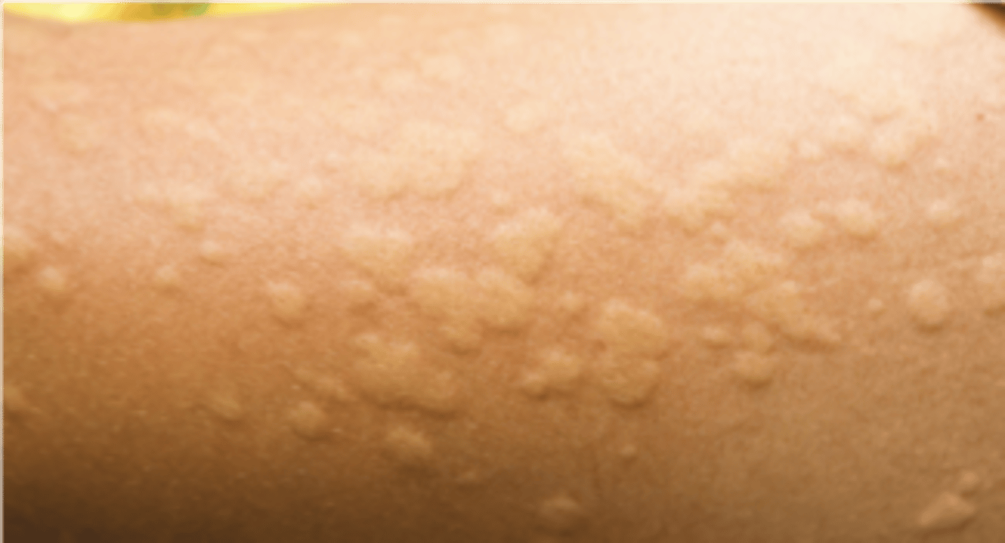 <p>name this skin pathology</p>