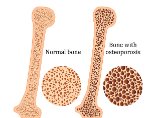 <p>degenerative disease in which the holes in the cancellous part of the bone become too wide - the bone becomes brittle and easy to break</p><p>typically caused by low calcium intake and old age</p>