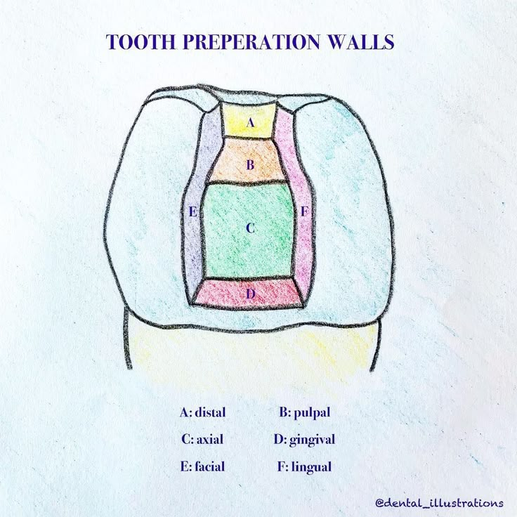 <p>Buccal portion of tooth preparation.</p>