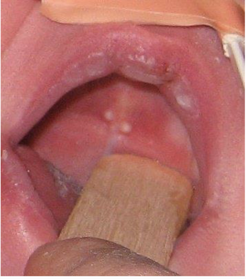 <p>The mother of a 2 month old baby has a concern of white nodules in the mouth of her kid. The clinical image is shown below. There is no pain or any other symptoms. Provide diagnosis</p>