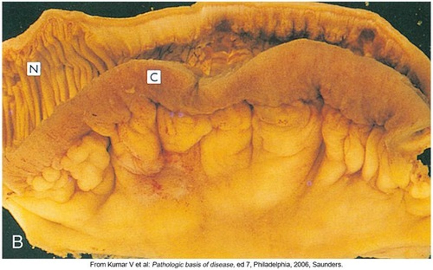 <p>Bloody stools.</p>