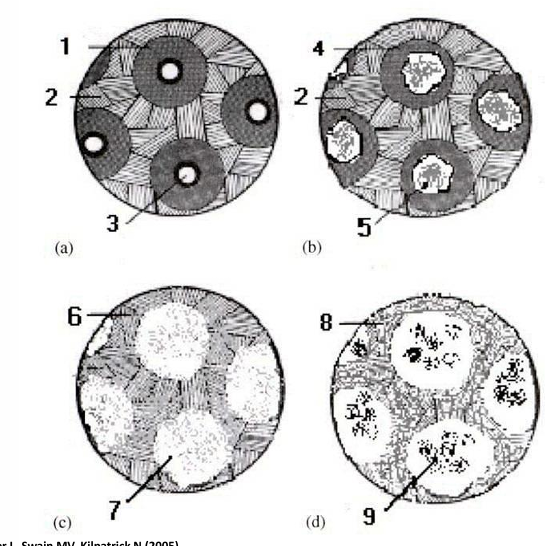 <p>-decalcification plus:</p><p>-degradation of ECM by bacterial proteases</p><p>-invasion of degraded intertubular dentin by bacteria</p>