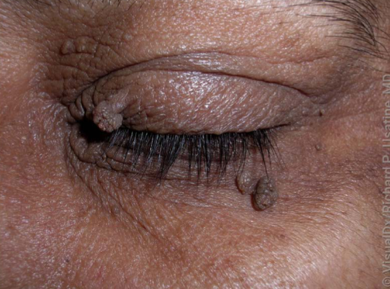 <p>skin tag characteristics </p>