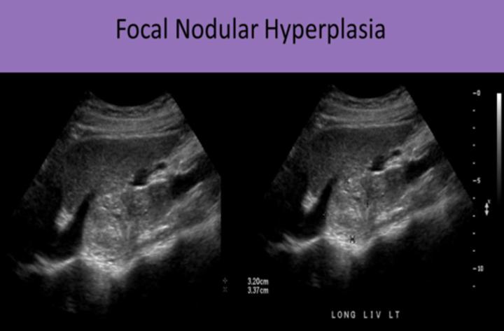 <p>1. #2 MOST COMMON BENIGN LIVER MASS<br>2. contains all normal liver parenchymal components, EXCEPT NORMAL PORTAL VENOUS STRUCTURES<br>3. most common in FEMALES IN CHILDBEARING YEARS<br>4. NOT ENCAPSULATED<br>5. ASYMPTOMATIC, NORMAL LFTs<br>6. SULFUR COLLOID IMAGING (nm exam) used to detect FNH</p>