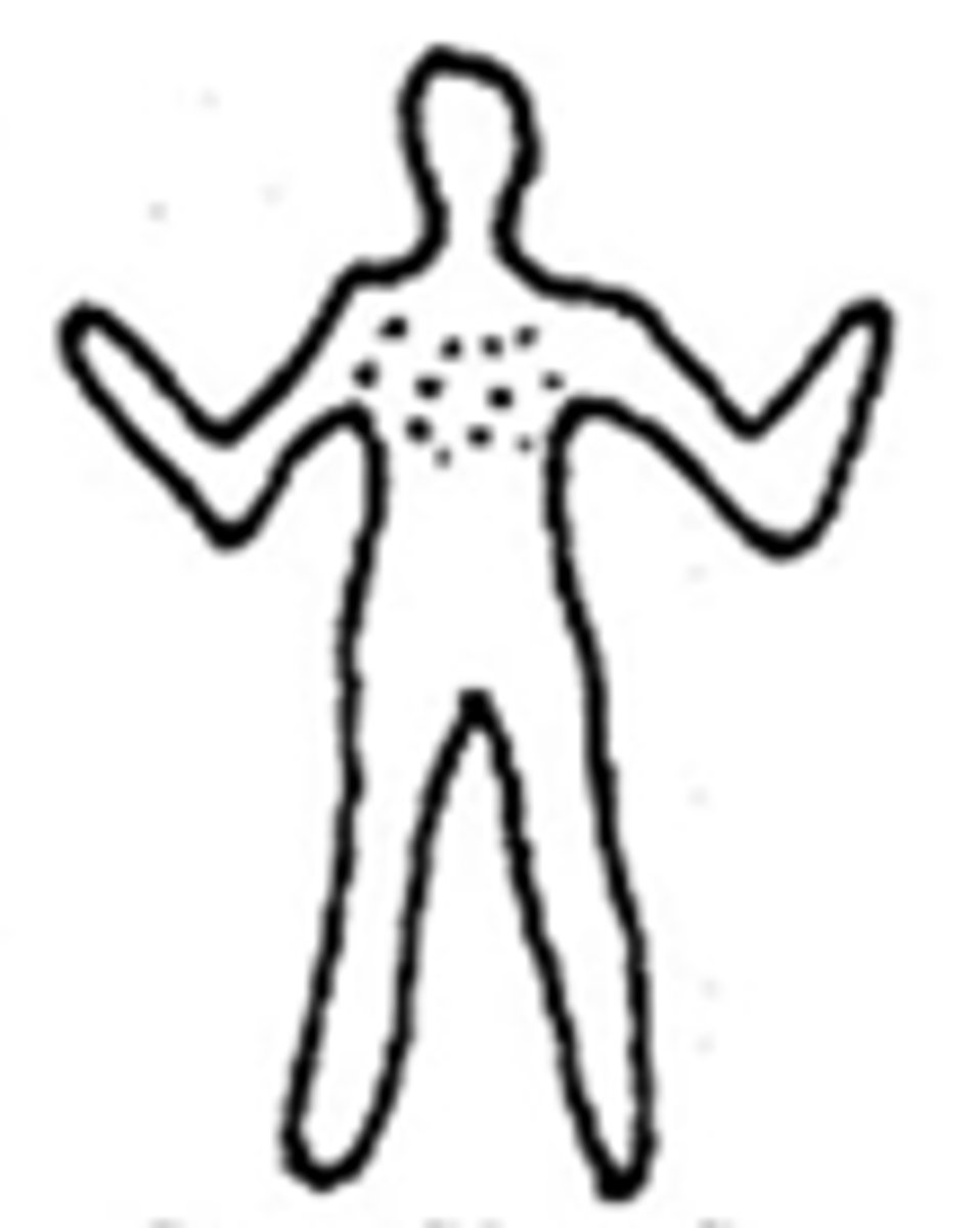 <p>Restricted to one particular body area</p>