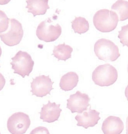 <p><span style="font-family: "Times New Roman", serif">RBCs with short, evenly spaced projections; reversible and may be artifact, but also seen in uremia or pyruvate kinase deficiency.</span></p>