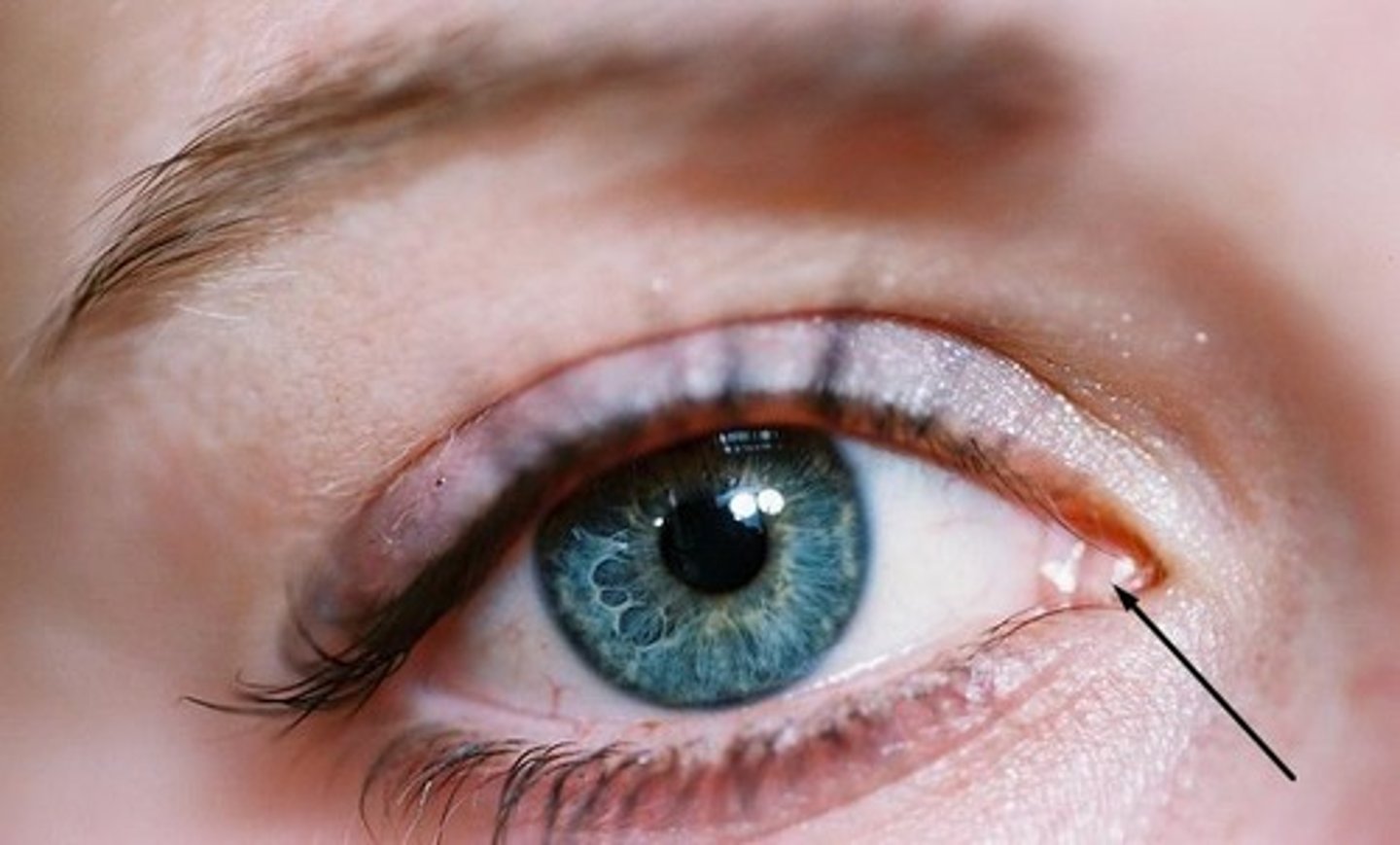 <p>fleshy elevation at the medial commissure; produces a whitish oily secretion</p>