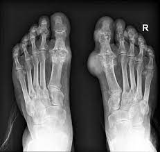 <p>a disorder in the metabolism of purine (a component of nucleic acids). Creates increases uric acid in the blood, which leads to the deposition of uric acid crystals in the joints, cartilage, and kidney. A very painful arthritis that initially attacks a single joint, primarily the first metatarsophalangeal joint.</p>