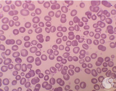 <p>what disease/condition is associated with stomatocytes?</p>