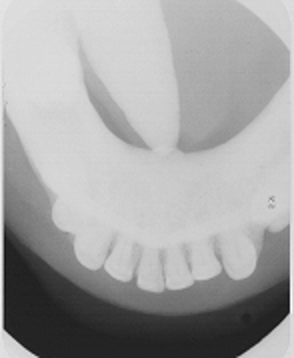 <p>ID the calcified abnormality:</p>