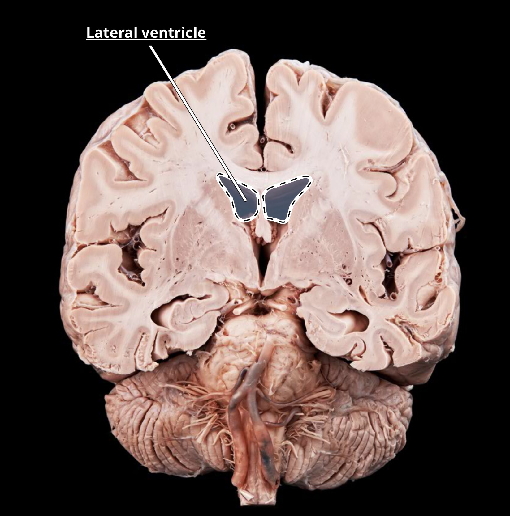 <p>lateral ventricles</p>